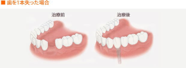 ■ 歯を1本失った場合