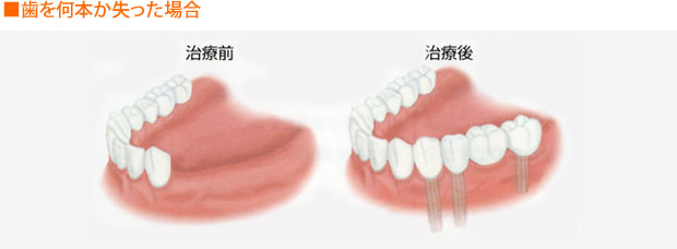 ■歯を何本か失った場合