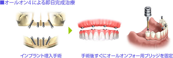 ■オールオンフォーによる即日完成治療